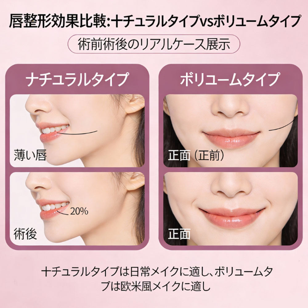 完美嘟嘟唇，唇部缩小术